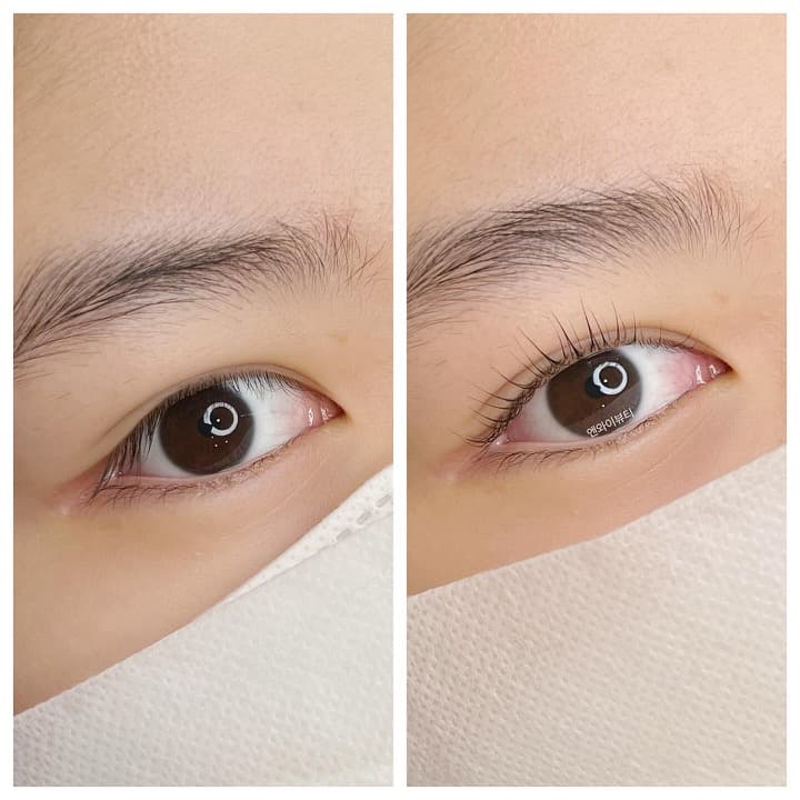 엔와이뷰티 시술 사진 1